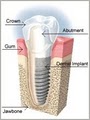 Periodontics Implants Colorado Springs - Dental Implants by Dr. Reich DDS, MS image 4
