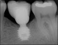Bicon Dental Implants image 2