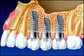 Pay Less For Teeth*Dental Implants*TMJ*Braces*Zoom*Root Canal*Veneers*TMD image 6