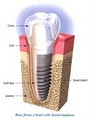 Pay Less For Teeth*Dental Implants*TMJ*Braces*Zoom*Root Canal*Veneers*TMD image 7