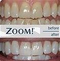 Pay Less For Teeth*Dental Implants*TMJ*Braces*Zoom*Root Canal*Veneers*TMD image 9