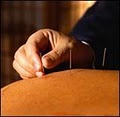 Irvine Acupuncture image 8