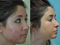 REJUVIMED -  Acne Scar treatment image 2