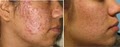 REJUVIMED -  Acne Scar treatment image 8