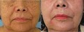 REJUVIMED -  Acne Scar treatment image 9
