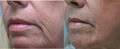 REJUVIMED -  Acne Scar treatment image 1
