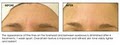 Skin Care Jacksonville, FL. HydraFacial and SkinMedica Treatments. image 3